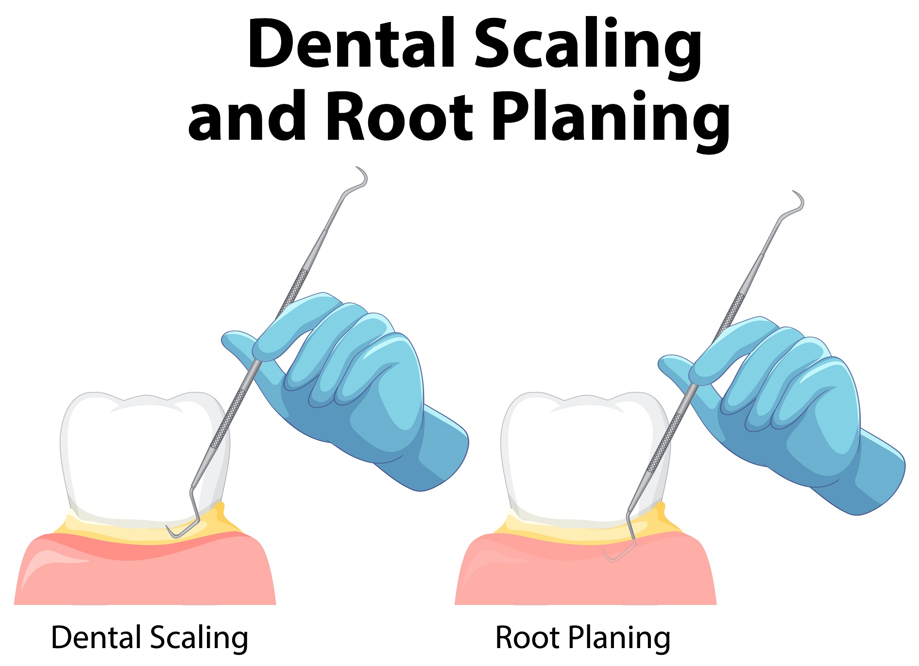 Clear Alginers illustration